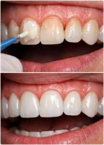 Composite veneer application and results