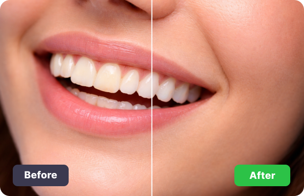 Dental Bonding in Brooklyn