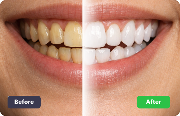 Teeth Whitening