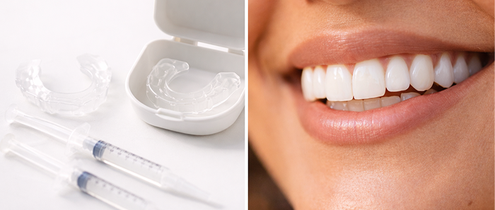 Brooklyn Whitening Treatment Photo