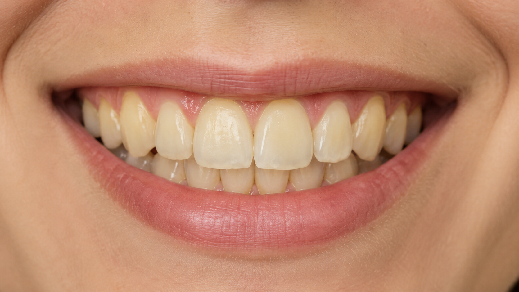 Before Teeth Whitening
