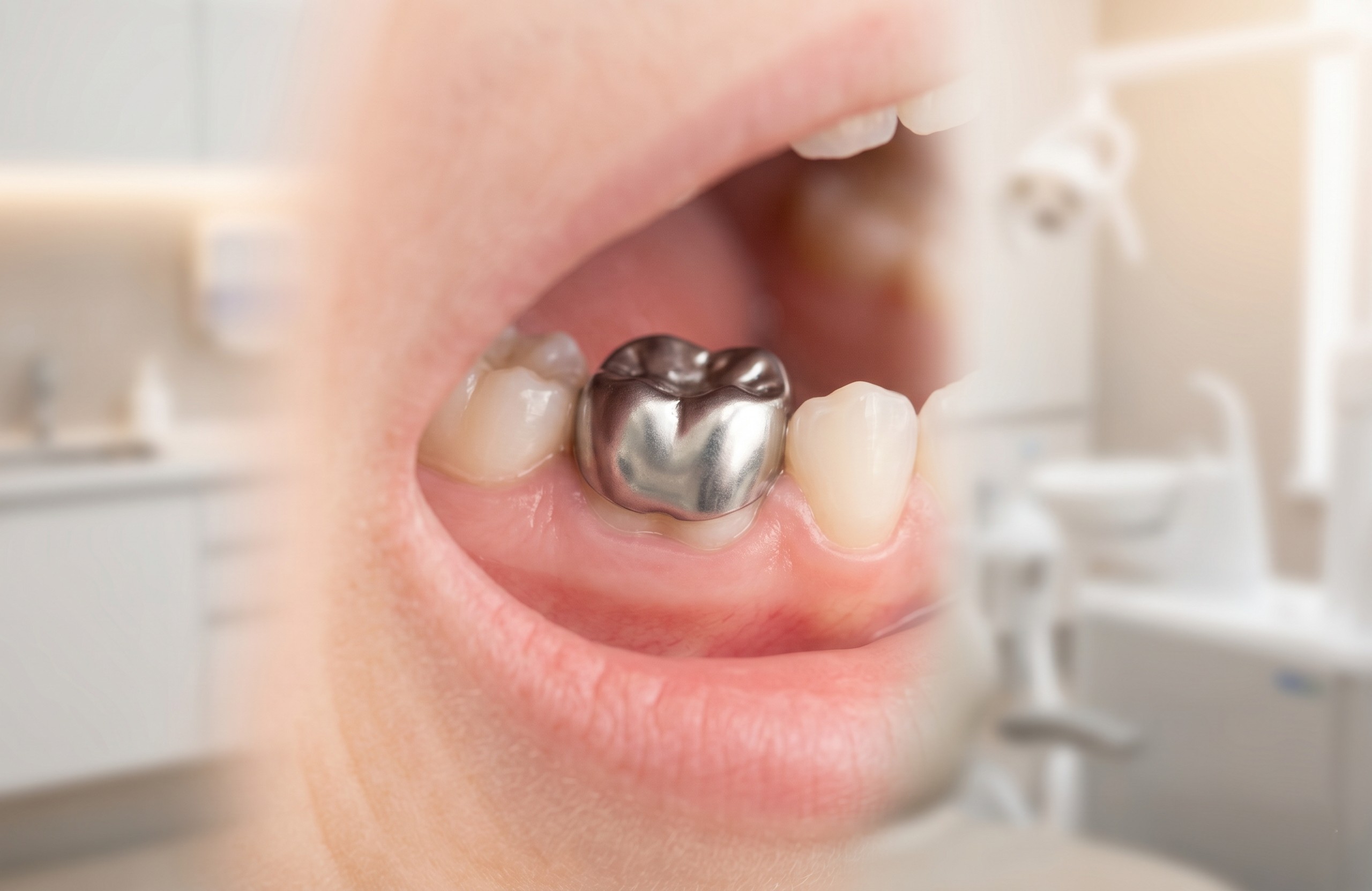 Clinical shot of stainless steel crown on baby molar