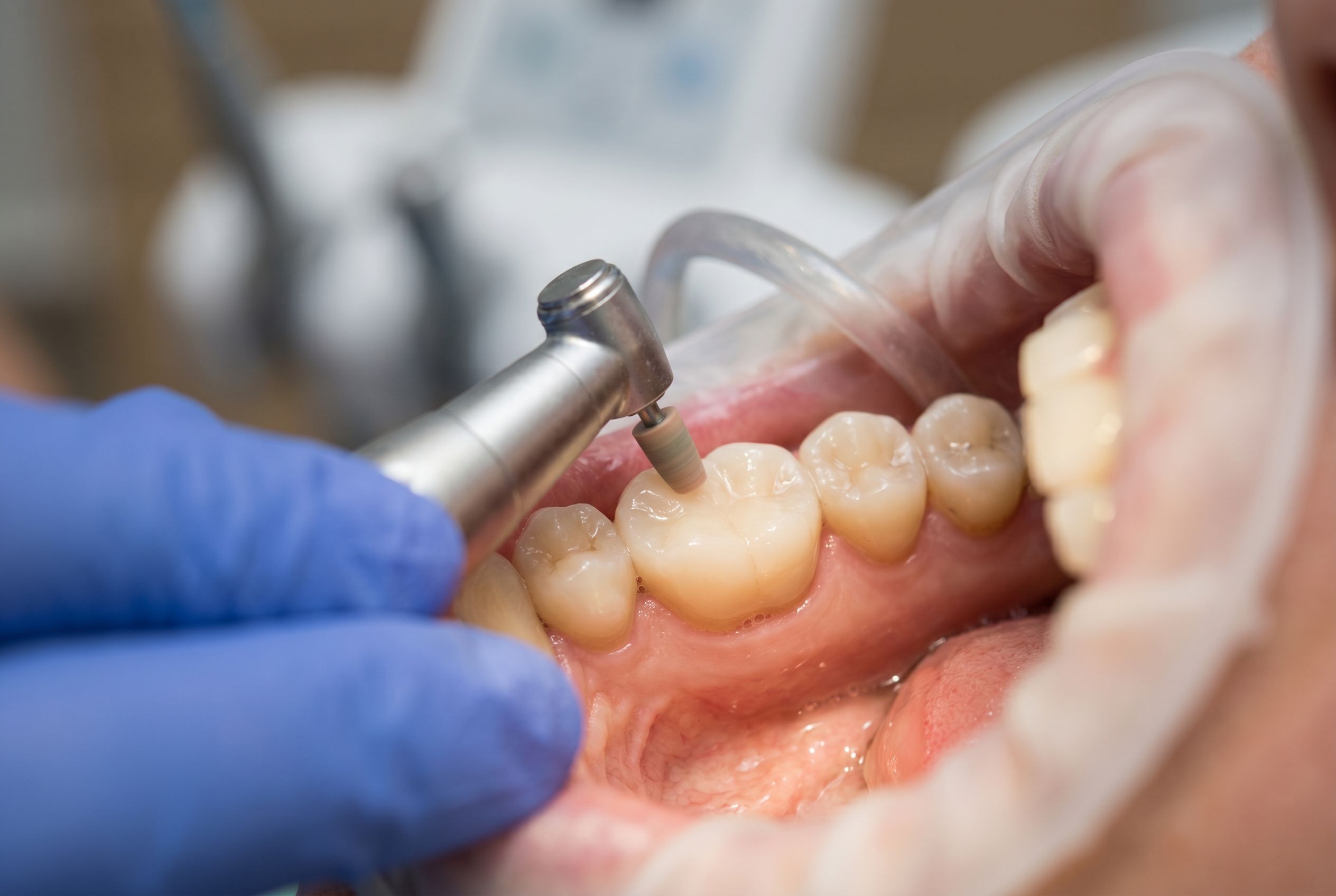 Composite Filling Close-Up Photo