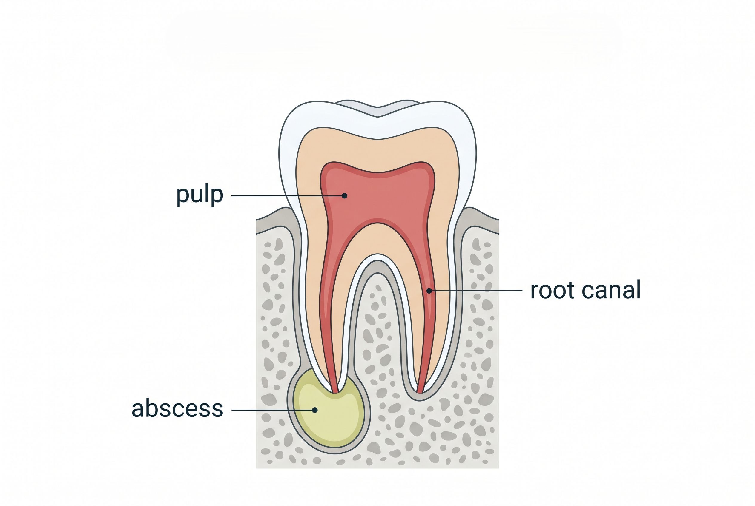 Tooth Abscess Diagram