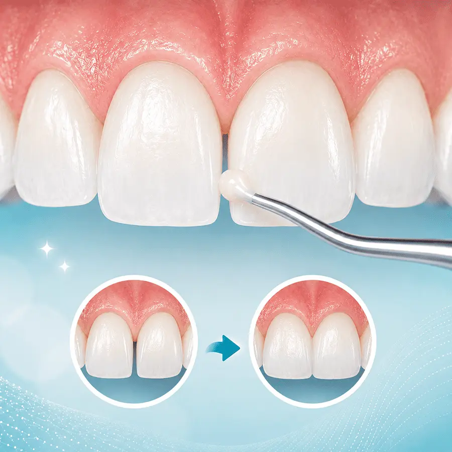 Dental bonding used to close a small gap between front teeth