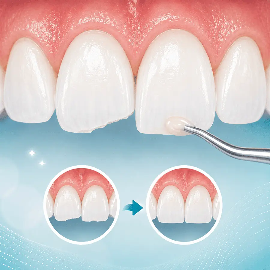 dental-bonding-uneven-teeth-brooklyn