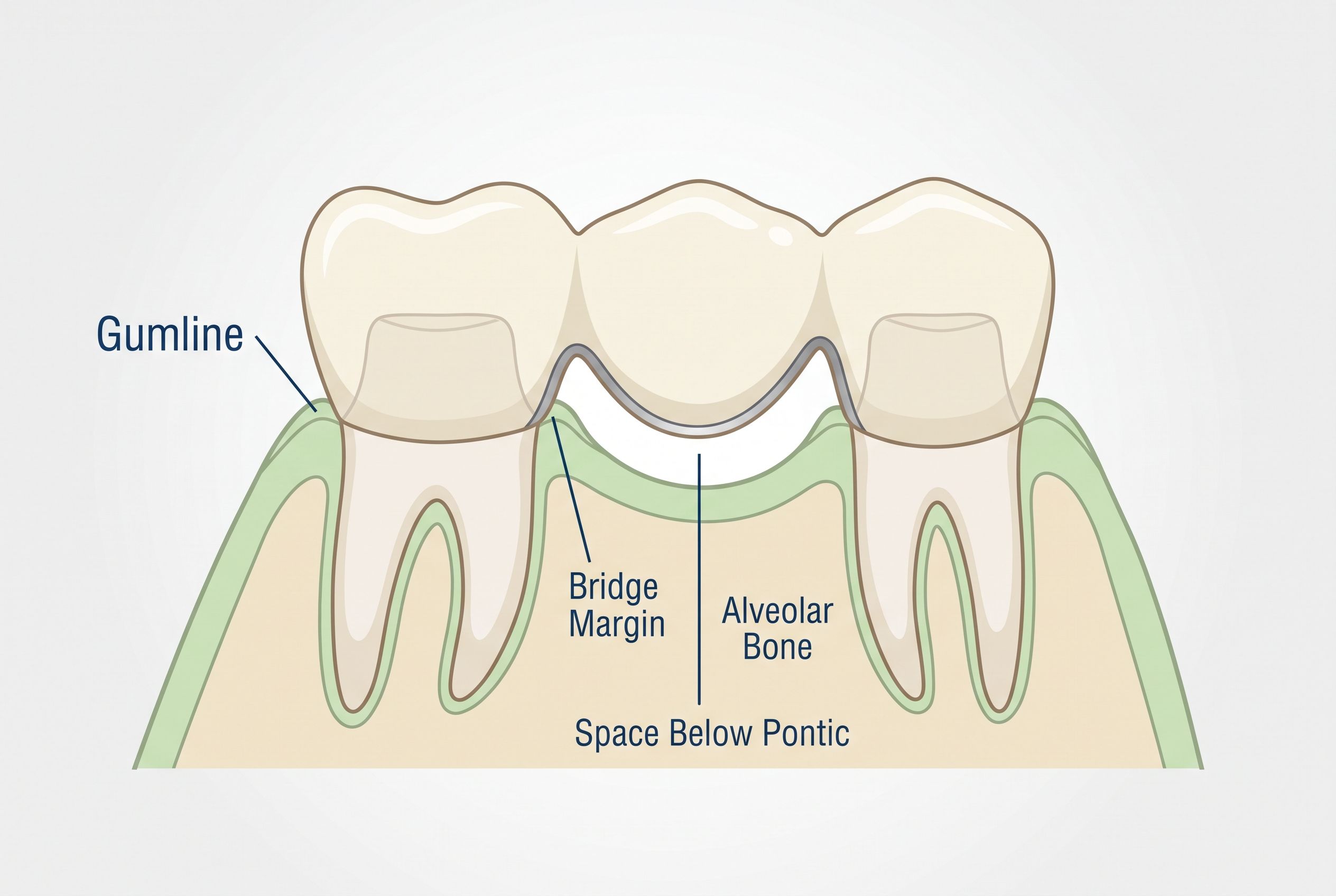 Dental Bridge Anatomy Diagram