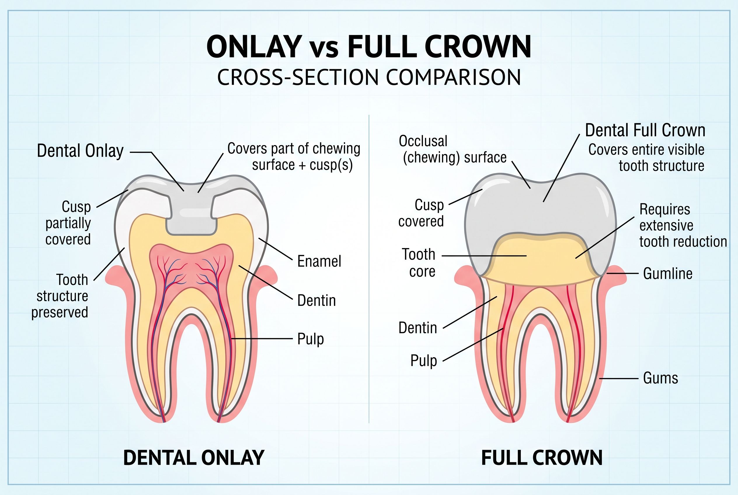 Onlay vs Crown Cross-Section Diagram