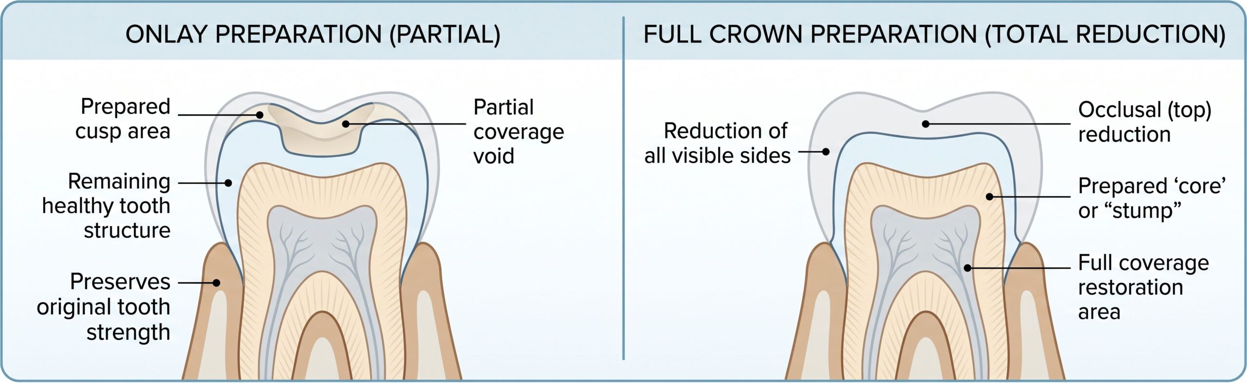 Onlay vs Crown Tooth Preparation Diagram