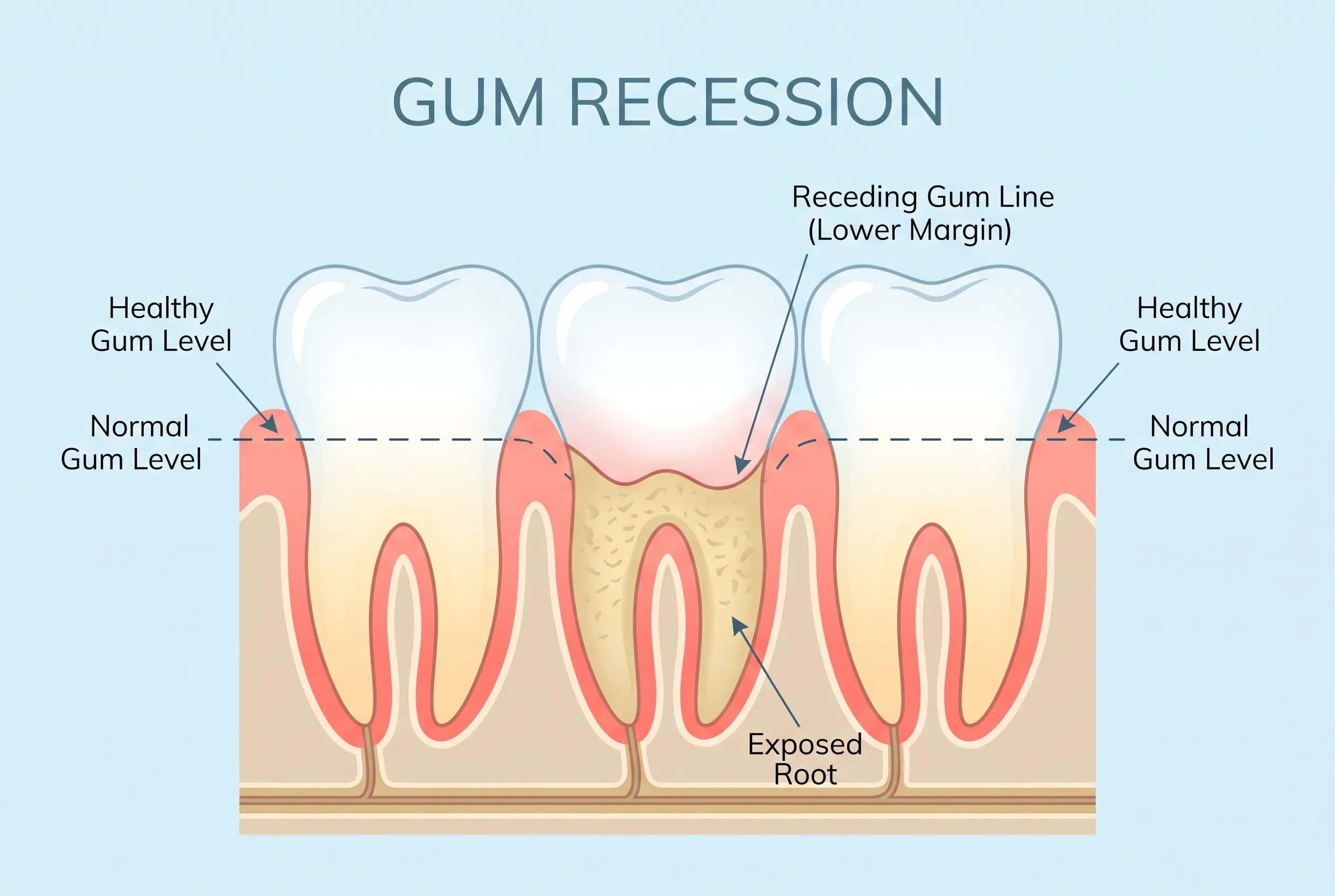 Gum Recession Diagram — One Tooth