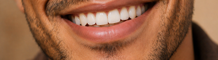 Veneer Smile Result